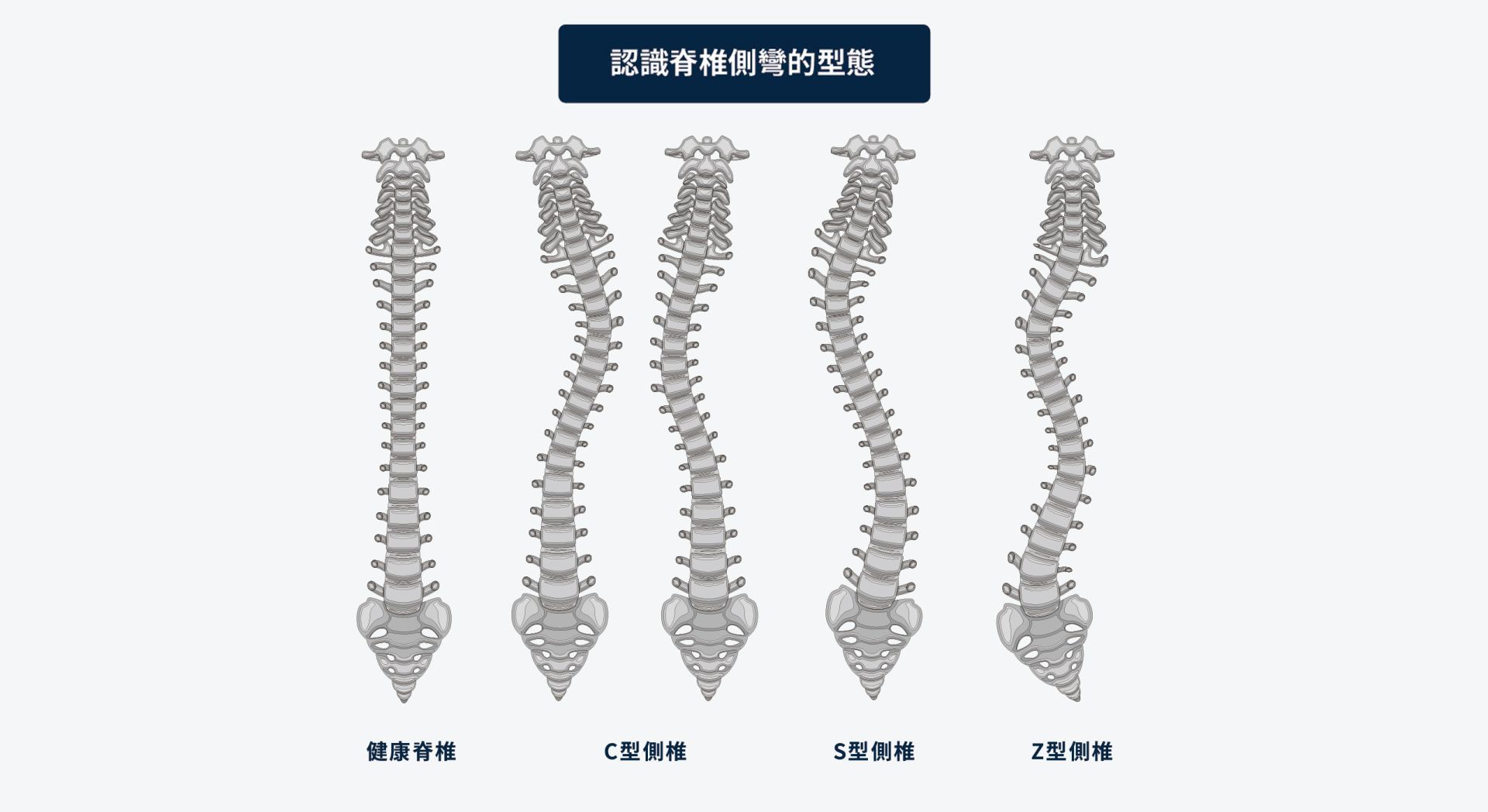 Scoliosis Curve Patterns
