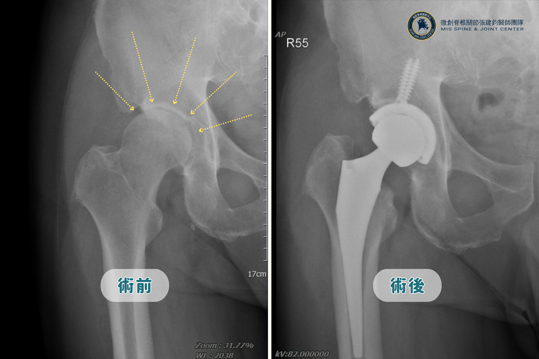 微創髖關節置換案例,當天下床、術後3-5天出院 微創髖關節置換案例,當天下床、術後3-5天出院