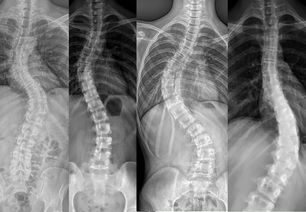 脊椎側彎超過45-50度或出現神經壓迫或內臟功能受損時，通常建議手術矯正。
