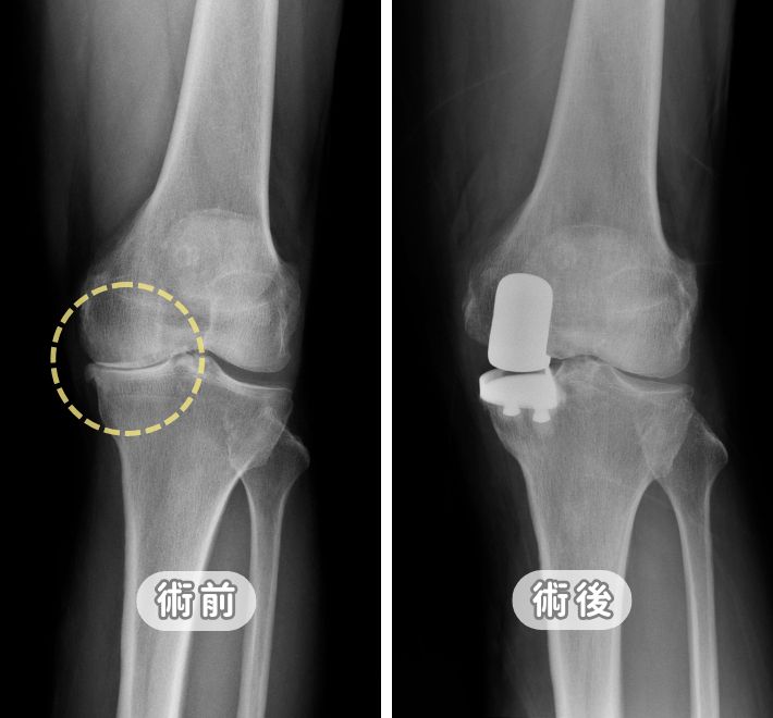 微創半膝人工關節置換手術案例，膝蓋關節退化不必整組換掉