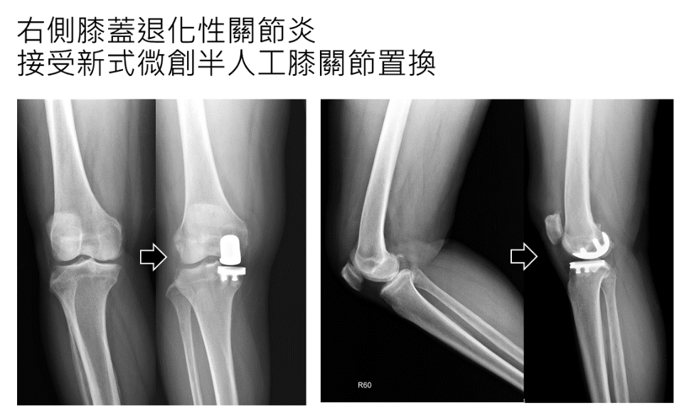 右側膝蓋退化性關節炎接受微創半膝人工關節置換