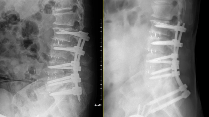 脊椎術後脊椎感染併發症，只好接受脊椎翻修手術