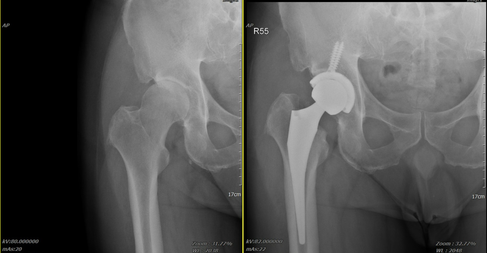 微創人工髖關節手術的傷口小、免復健 微創人工髖關節手術的傷口小、免復健