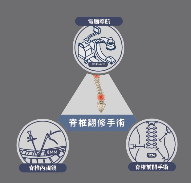 脊椎翻修手術藉由電腦導航、脊椎內視鏡、及前開路徑，提高安全性