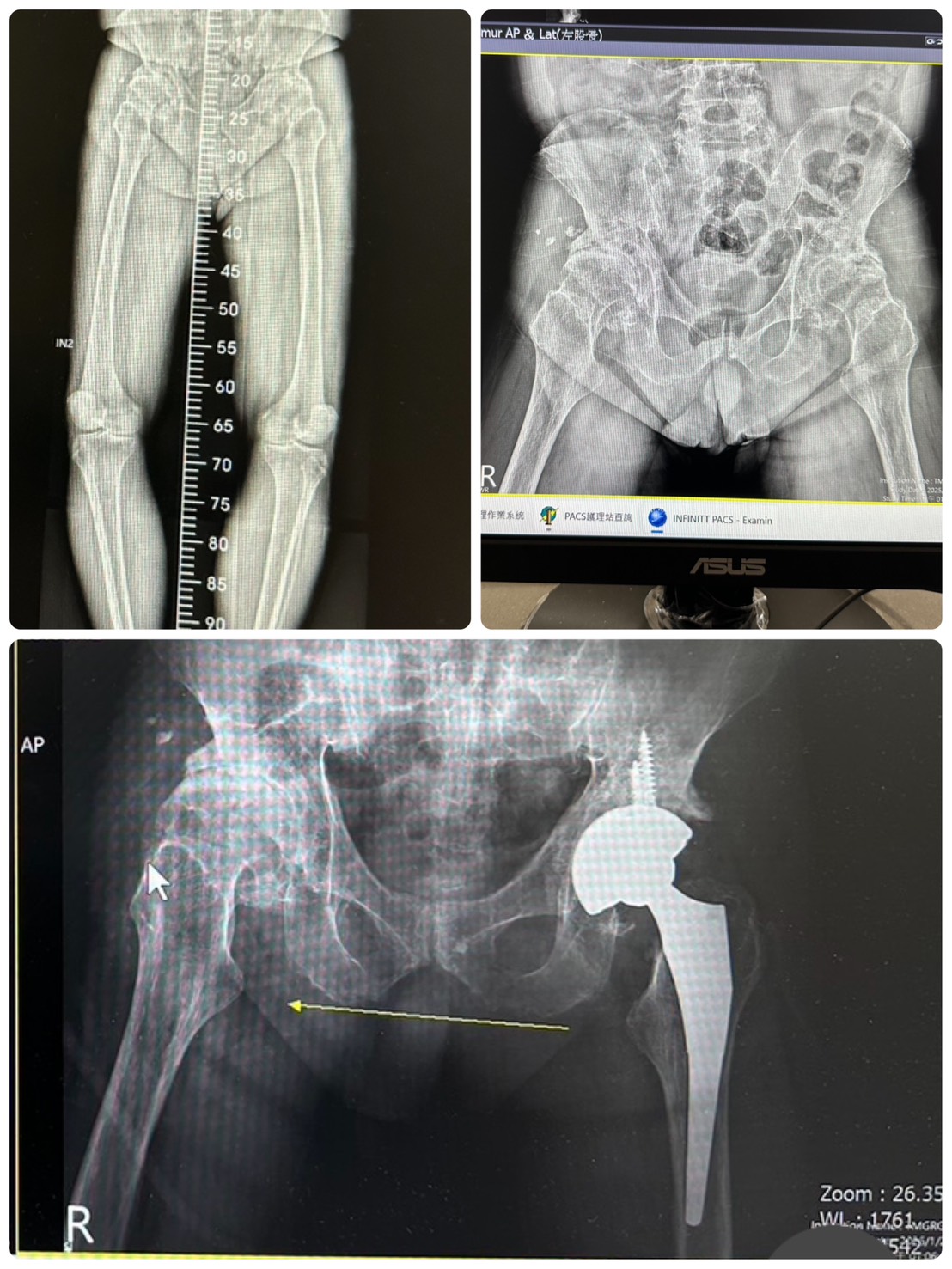 微創髖關節置換手術實際案例 微創髖關節置換手術實際案例