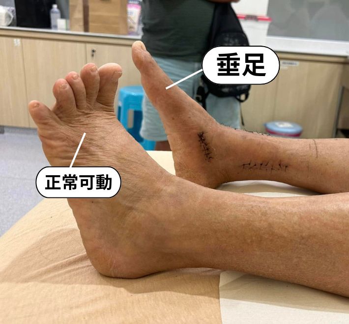 出現垂足症狀建議做3D電腦導航微創手術 出現垂足症狀建議做3D電腦導航微創手術