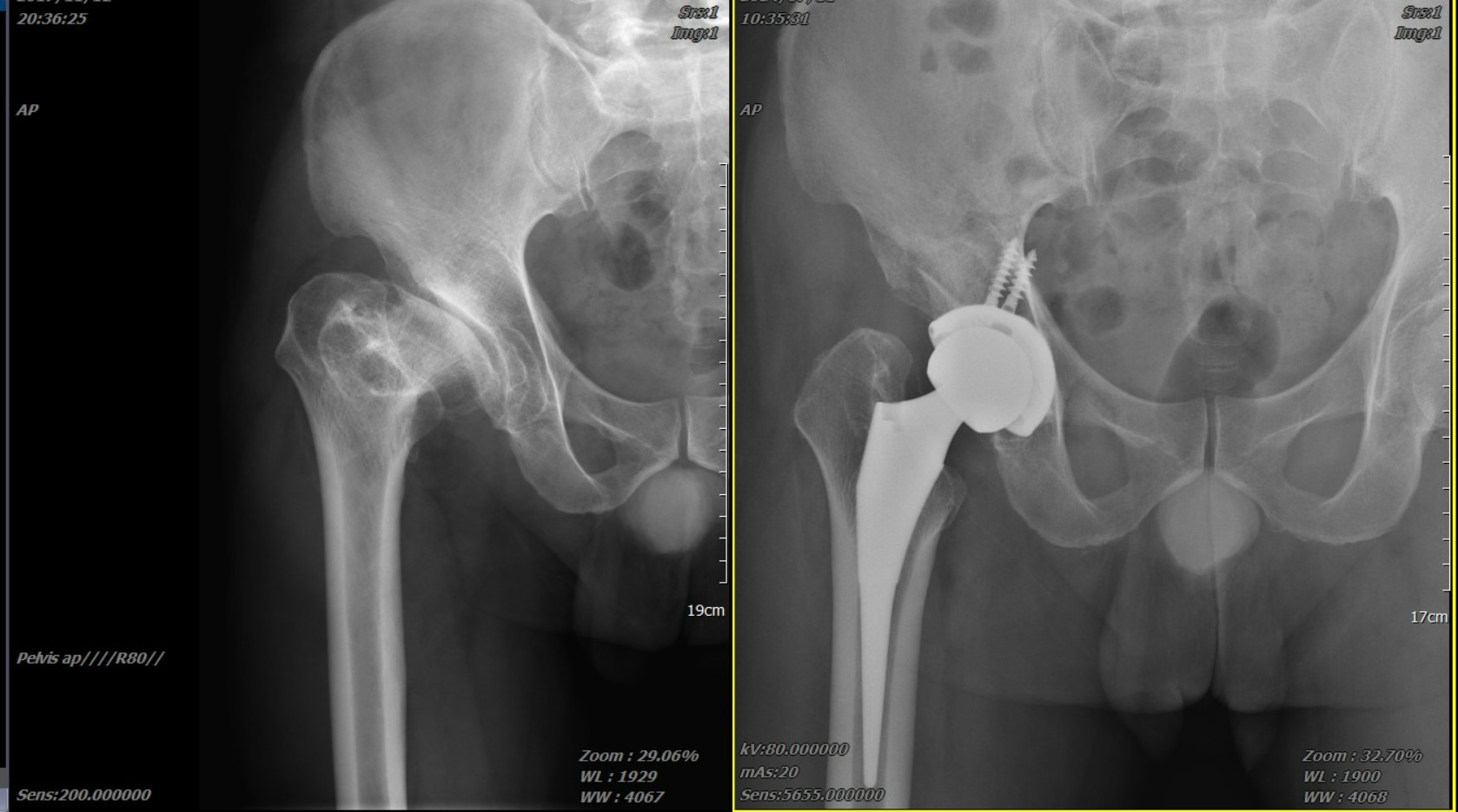 髖關節退化常見症狀有鼠蹊部（ 腹股溝）疼痛、關節僵硬及長短腳