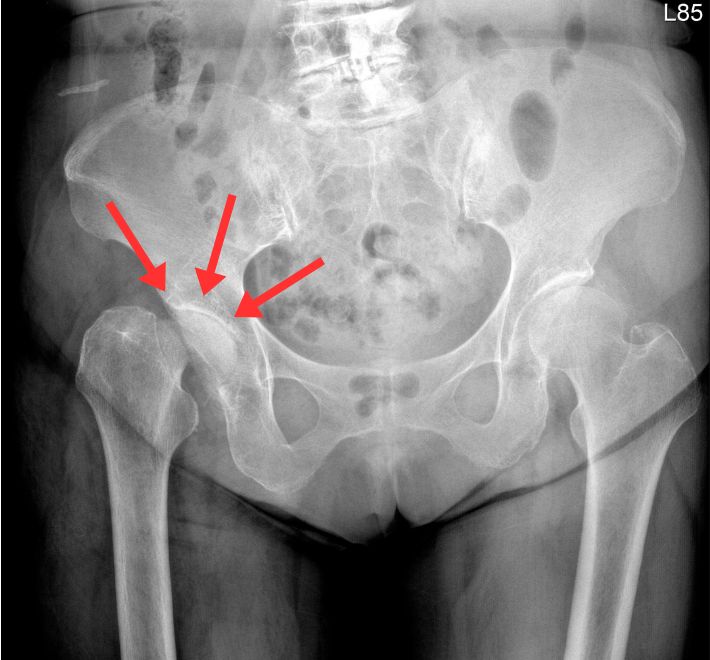 單側髖關節嚴重退化、骨頭變形時骨盆會傾斜呈現長短腳