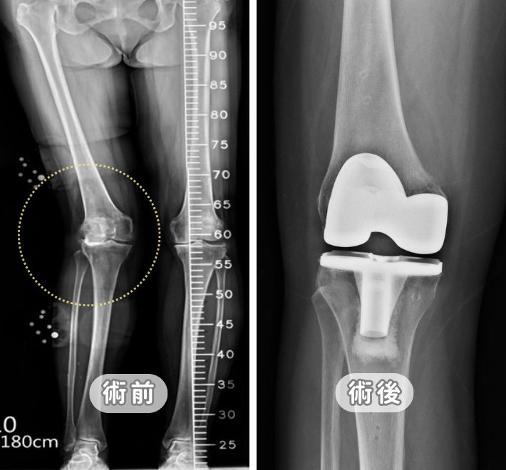 膝關節退化治療：初期症狀、復健運動到人工關節置換