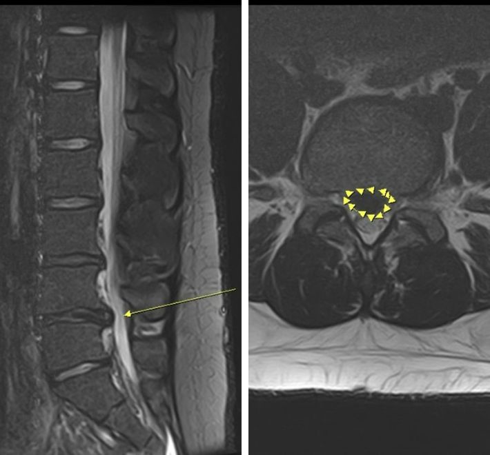 椎間盤突出成因、症狀、保守治療與微創治療全解析 椎間盤突出成因、症狀、保守治療與微創治療全解析