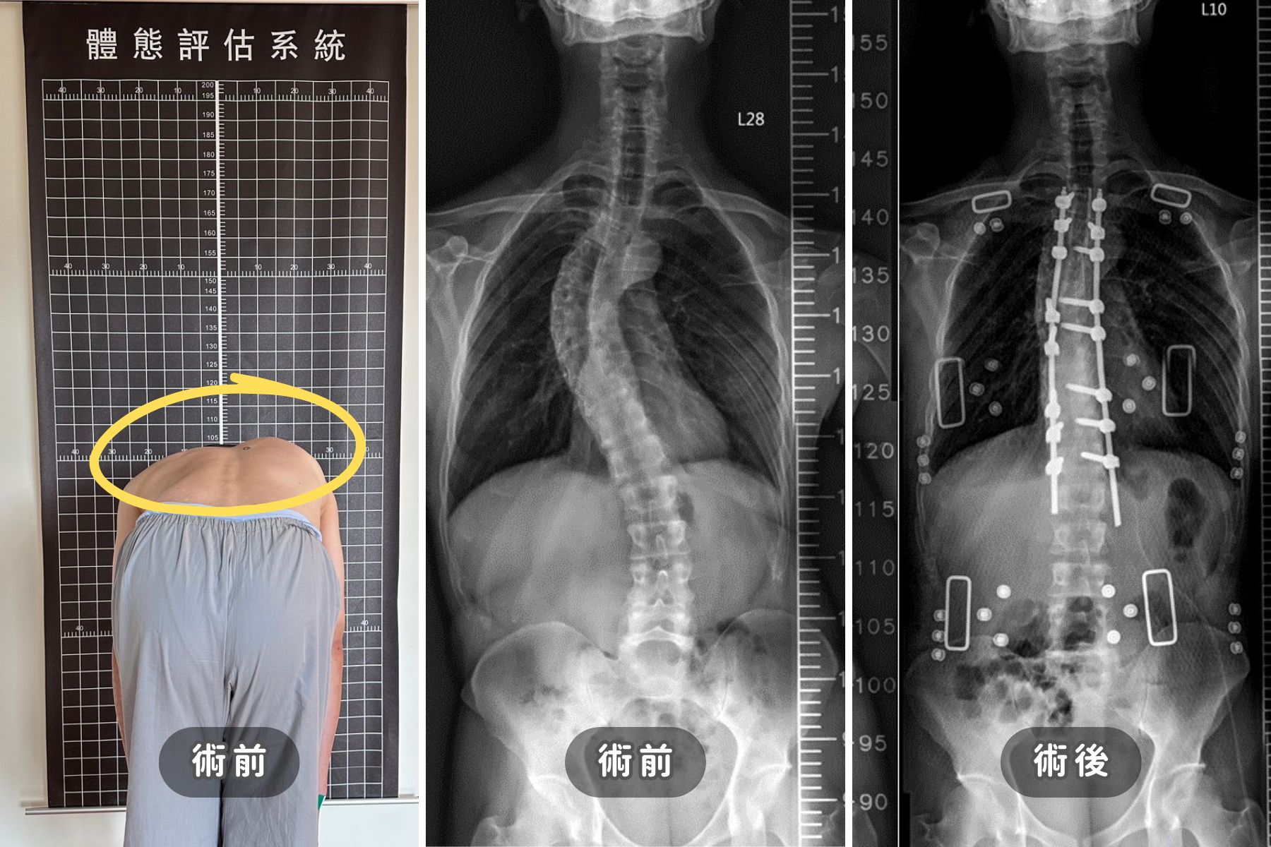 張建鈞醫師重度脊椎側彎案例 張建鈞醫師重度脊椎側彎案例