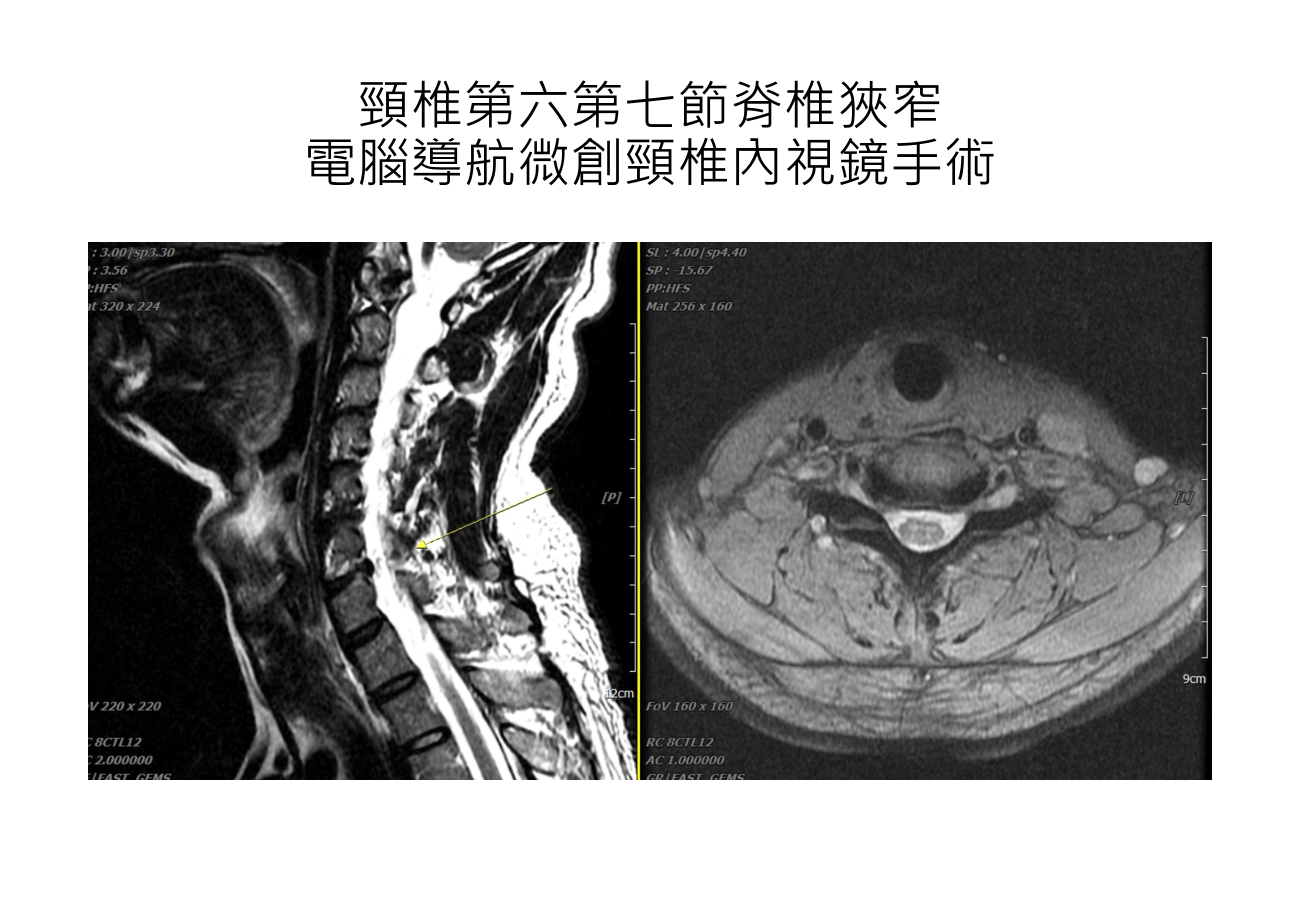 內視鏡技術讓頸椎手術只會留下微創傷口