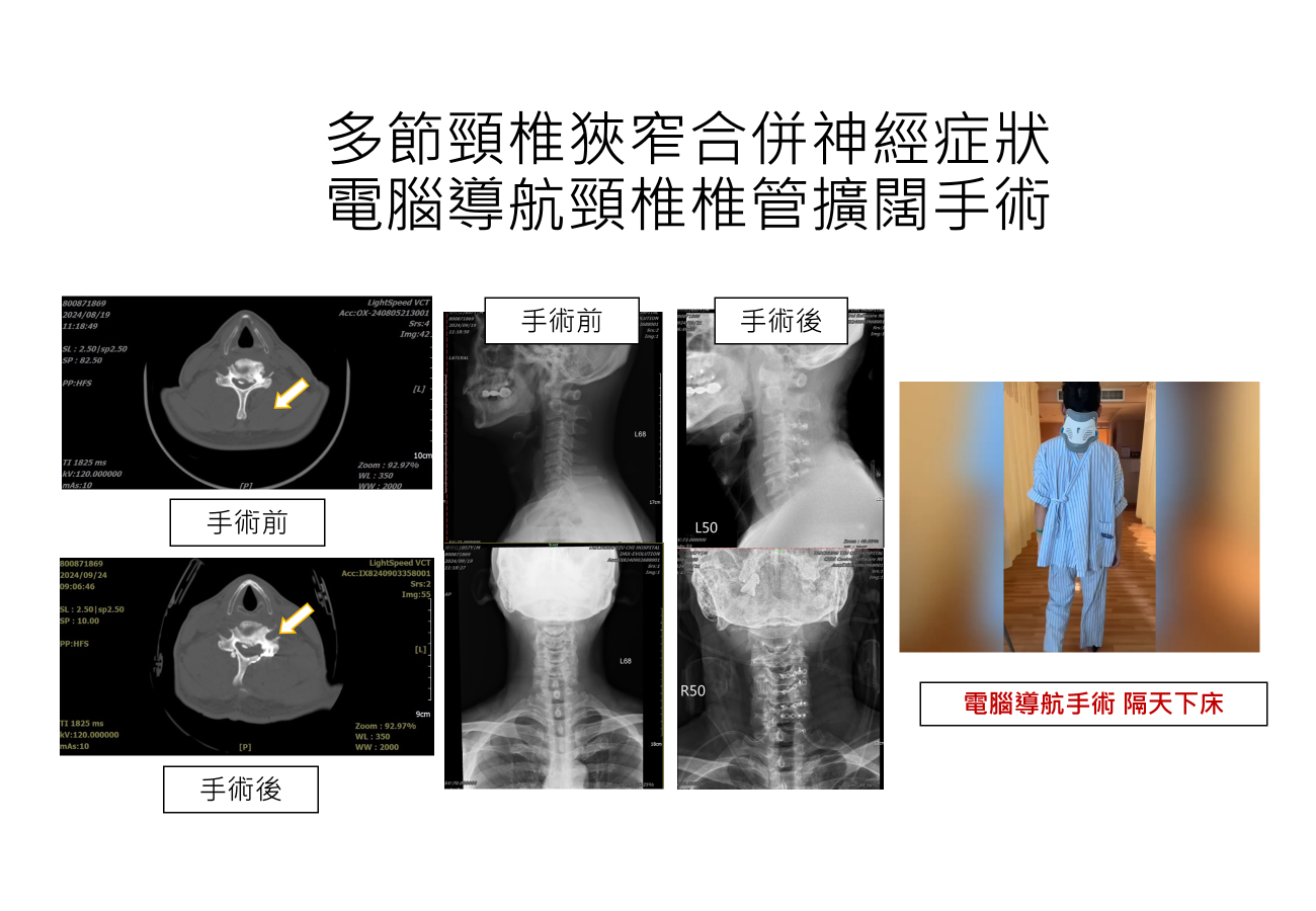 3D電腦導航頸椎微創手術術後隔天即可下床走動