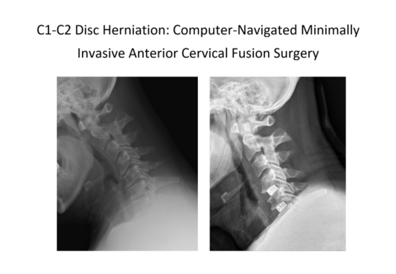 內視鏡技術讓頸椎手術只會留下微創傷口