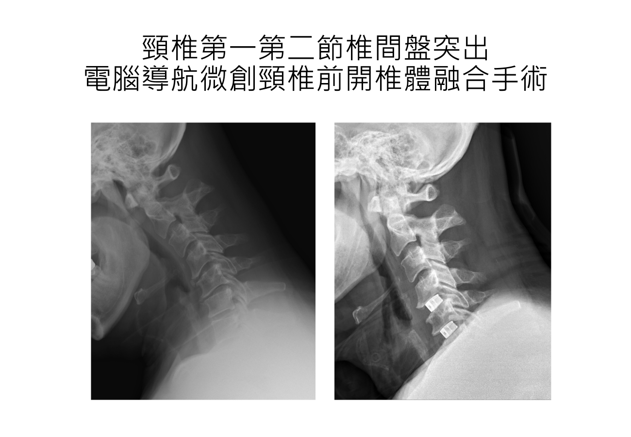 3D電腦導航微創頸椎前開手術的案例對比