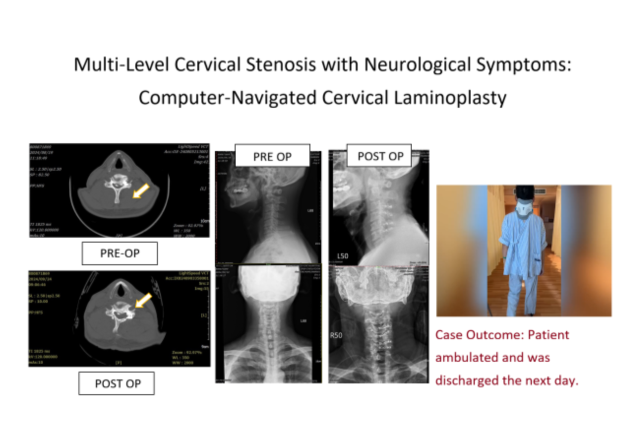 3D電腦導航頸椎微創手術術後隔天即可下床走動