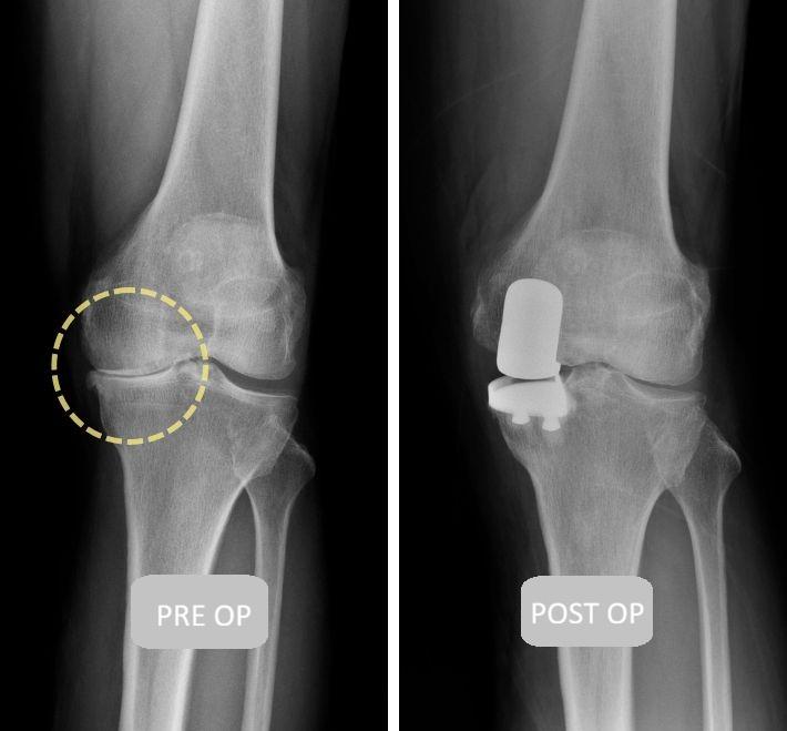 The Complete Guide to Minimally Invasive Unicompartmental Knee Arthroplasty (UKA): Precision Treatment and Rapid Recovery to Alleviate Knee Degenerative Pain