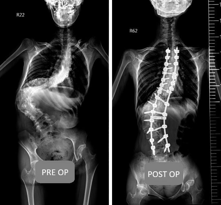 The Complete Guide to Scoliosis Surgery: From the Golden Window of Treatment to Minimally Invasive Techniques — A Surgeon’s Explanation of Key Factors for Safe Correction
