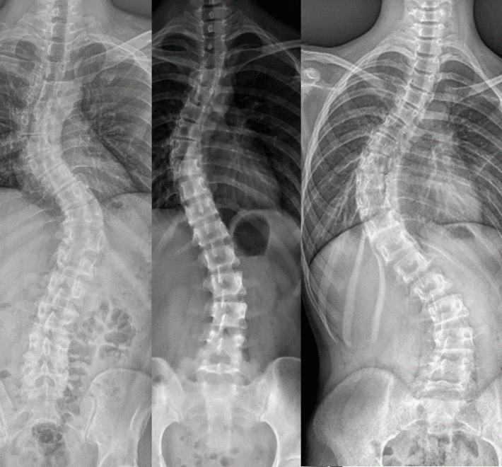 Scoliosis: Comprehensive Guide — Types, Screening & Minimally Invasive Correction