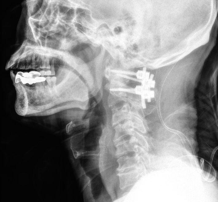 The Complete Guide to Minimally Invasive Cervical Spine Surgery: How "Navigated Minimally Invasive" Techniques Precisely Relieve Nerve Compression and Speed Recovery