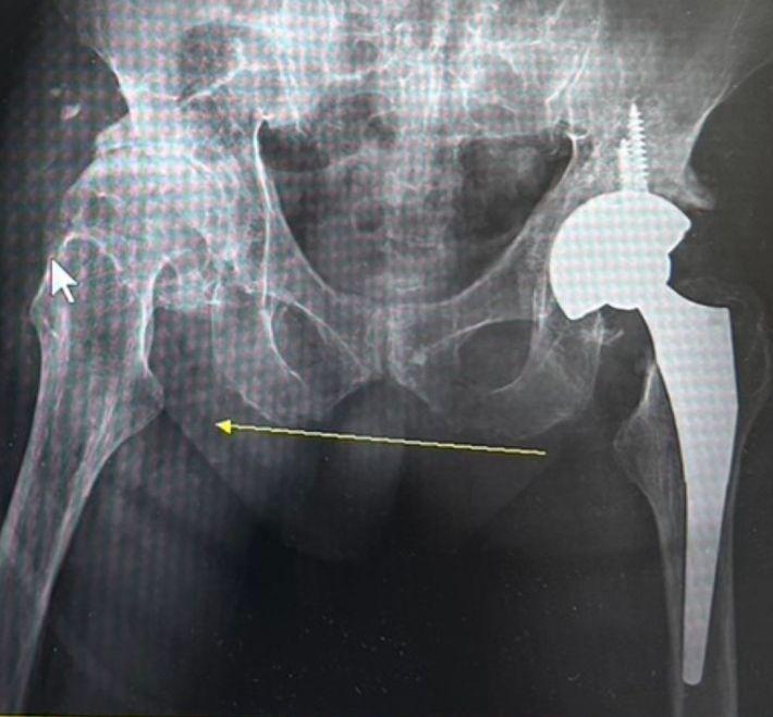 The Complete Guide to Minimally Invasive Hip Replacement Surgery: Smaller Incision, Rehab-Free Recovery, Regain Your Stride