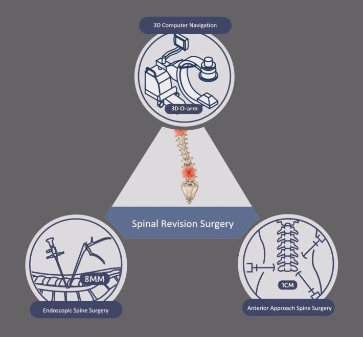 The Complete Guide to Spine Revision Surgery: When a "Second Surgery" Becomes Necessary, How to Control the Risks?