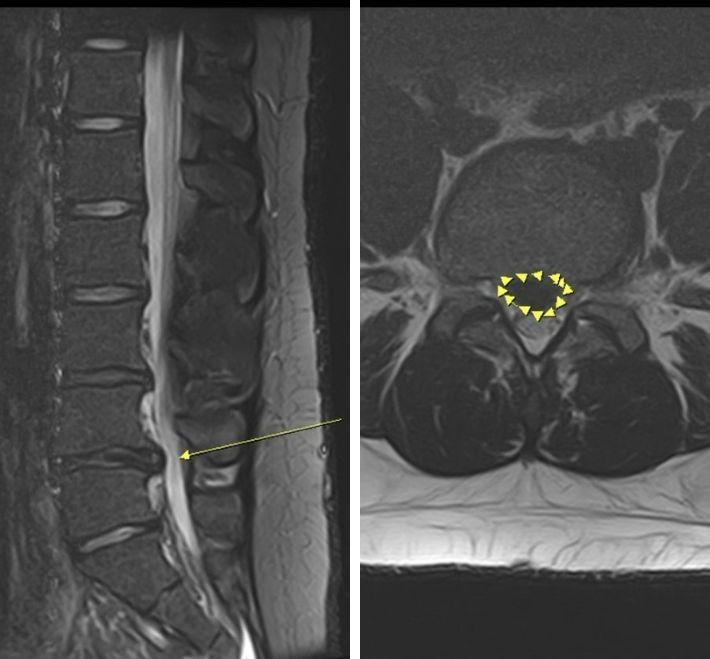 Herniated Disc Treatment: Can It Heal on Its Own? Spontaneous Recovery & Acute Care Guide