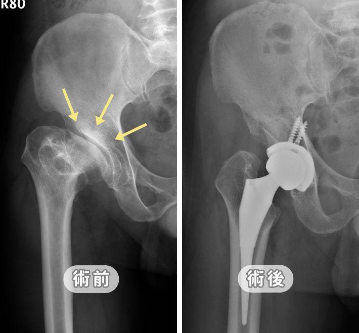 Groin Pain Keeping You from Walking? A 30-Second Self-Test for Hip Osteoarthritis & Treatment Evaluation