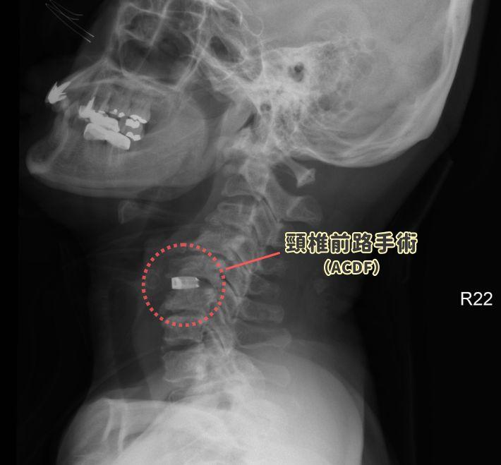 Require Major Open Surgery? A Guide to Three Mainstream Minimally Invasive Procedures and Recovery Timelines