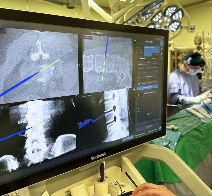 微創新式脊椎手術的科技革命：3D電腦導航如何實現「小傷口、低疼痛、快復原」？