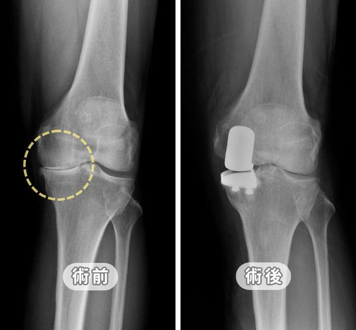 微創半膝人工關節置換（UKA）全攻略：精準治療與快速恢復，告別膝蓋退化痛
