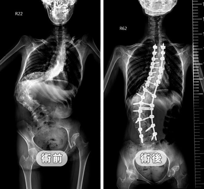脊椎側彎手術全攻略：從治療黃金時機到微創技術，醫師詳解安全矯正關鍵