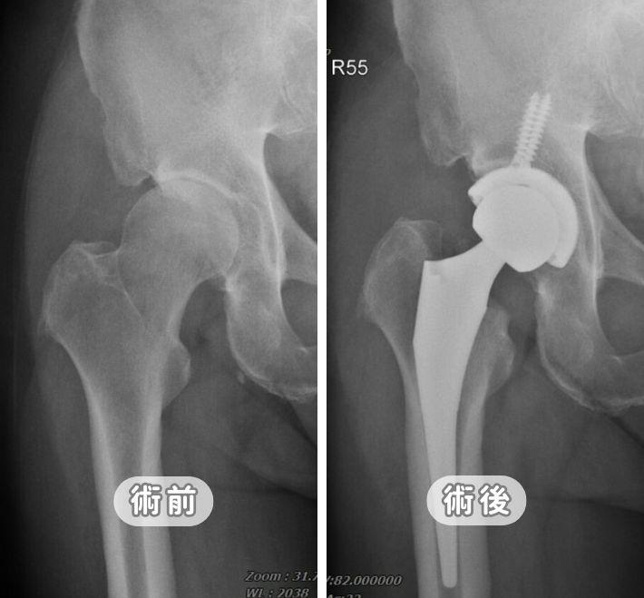 微創人工髖關節手術全攻略：傷口小、免復健、重新大步走路