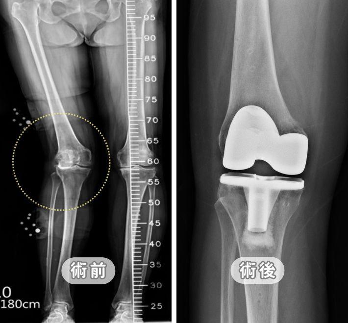 【告別膝關節退化】治療全攻略：初期症狀、復健運動到人工關節置換，醫師詳解保膝關鍵