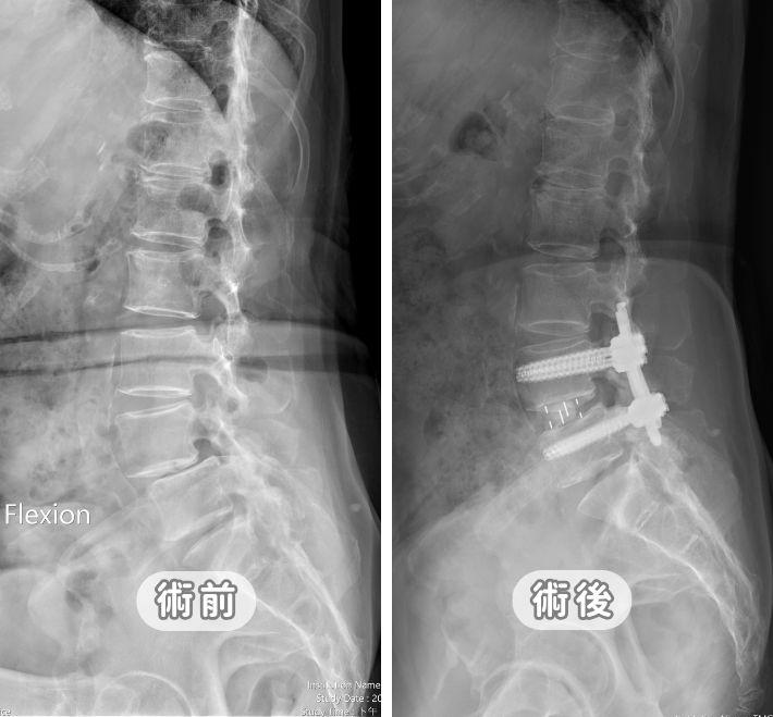 【脊椎滑脫最新全攻略】症狀原因、復健與手術時機：從第一級到第五級的精準治療建議