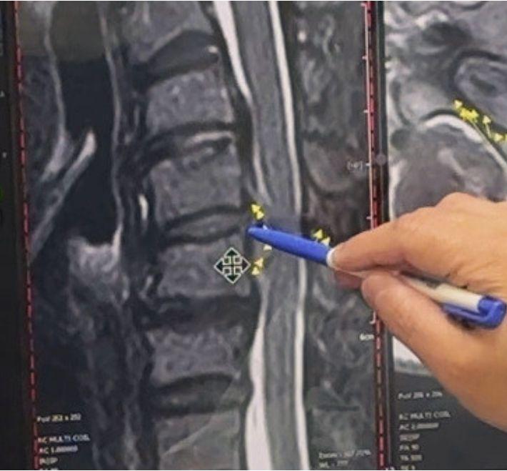 椎間盤突出手術後多久能下床?術後24小時恢復教學
