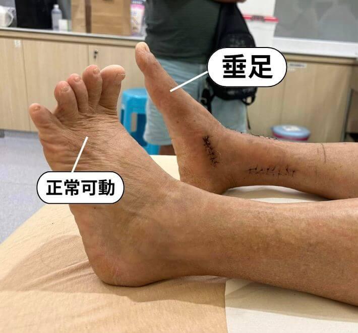 脊椎滑脫運動安全指引:避免「反覆性」姿勢造成過度負擔