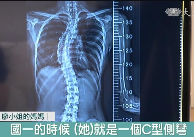 脊椎側彎矯正|微創手術標準化 先進設備新技術